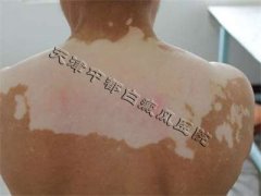 <b>治疗中白癜风还扩散，原因在这......</b>