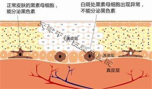 儿童白癜风容易治吗